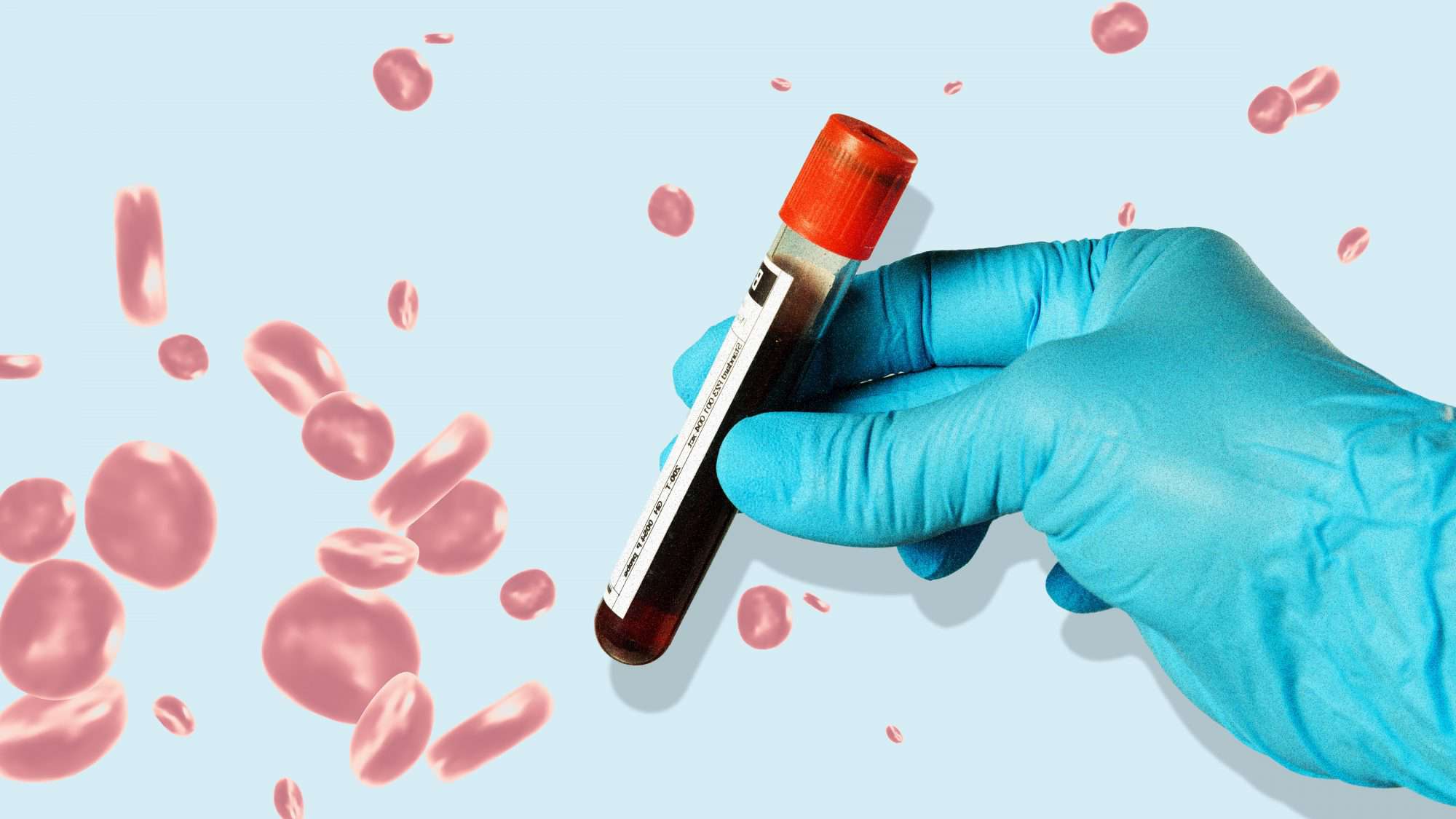 Pancreatic cancer ovarian cancer liver cancer early detection blood test screening advancement